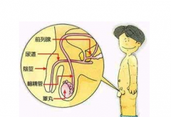 急性前列腺炎