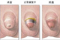 包皮手术怎么做